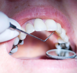 Dental Amalgam
